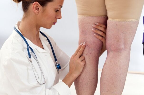 Traitement des varices chez les femmes