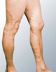 Varices dans les jambes d'un homme