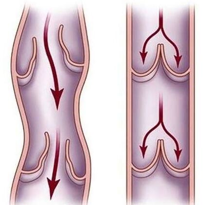 Varices