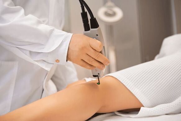 Coagulation laser des veines des membres inférieurs