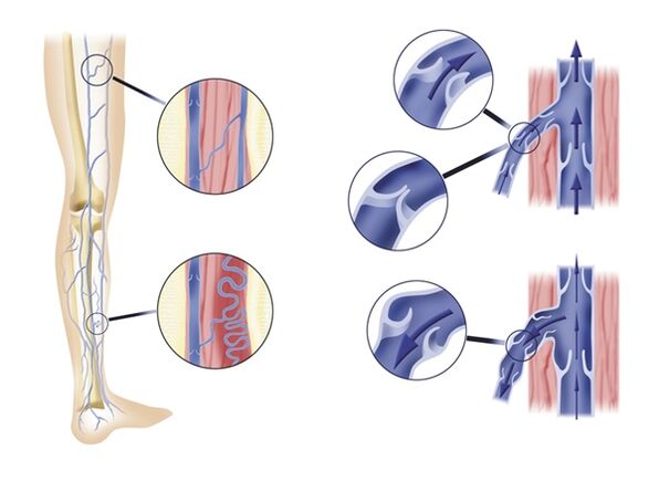 Des valvules veineuses incompétentes entraînent des varices