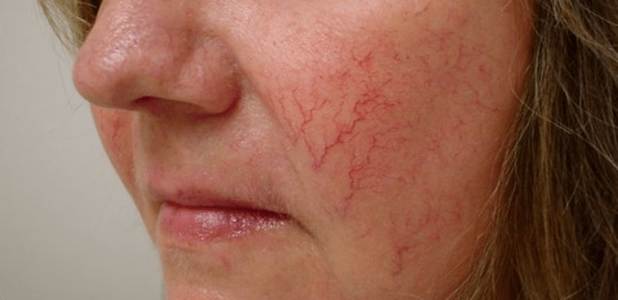 varices sur le visage comment traiter